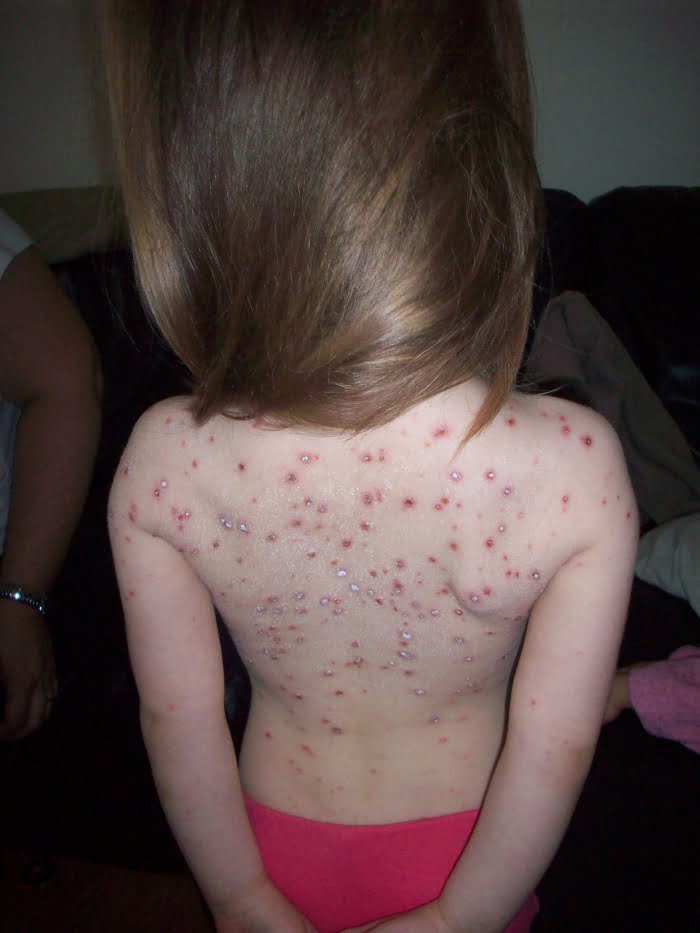 Can't Catch Chicken Pox