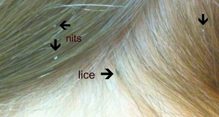 Get Rid of Head Lice Naturally