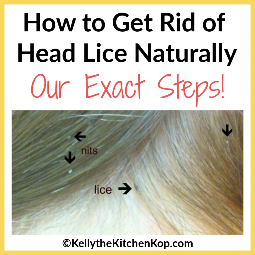 Head lice: What is it and what is the best treatment to get rid of it