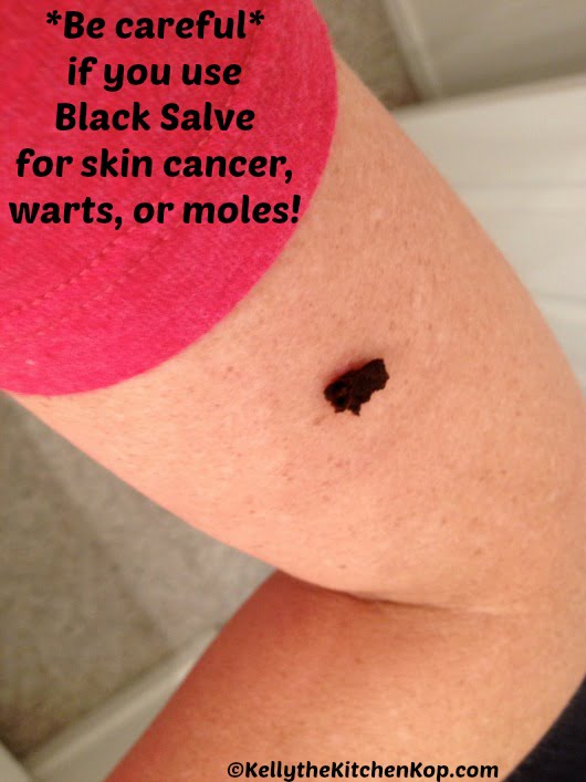 black salve for skin cancer