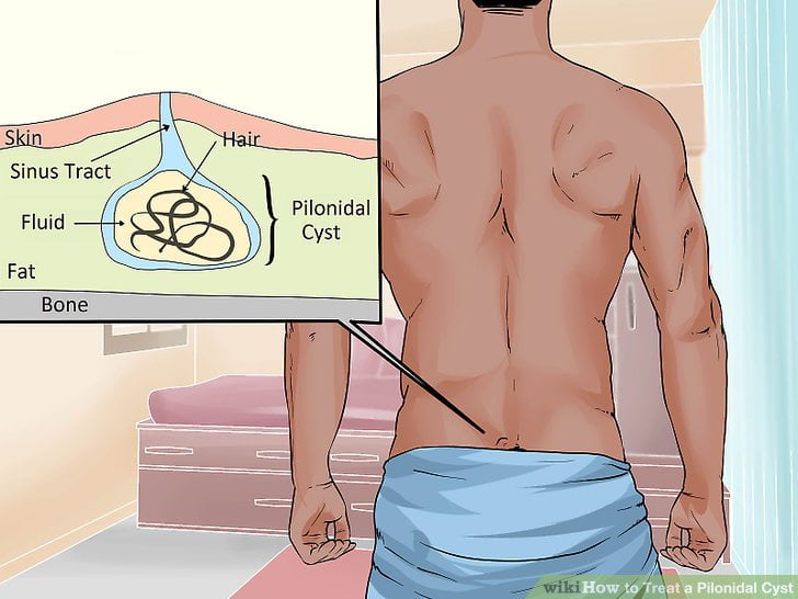 Pilonidal Abscess