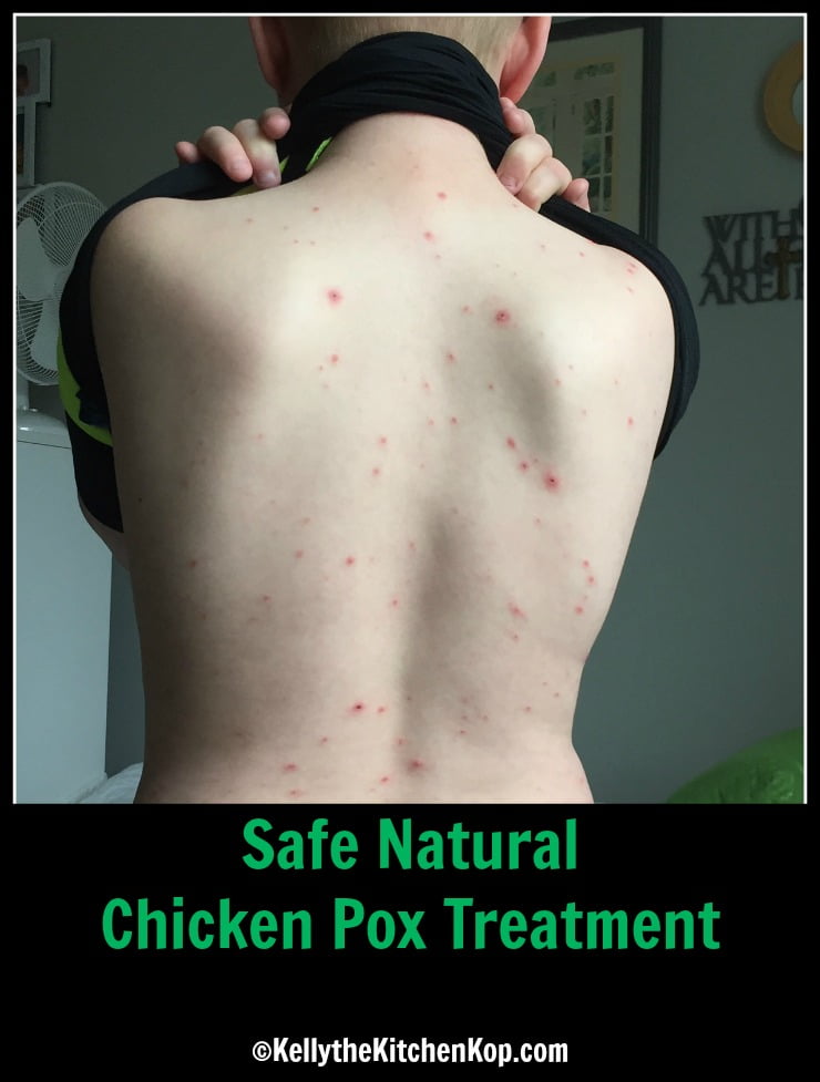 Safe Natural Chicken Pox Treatment