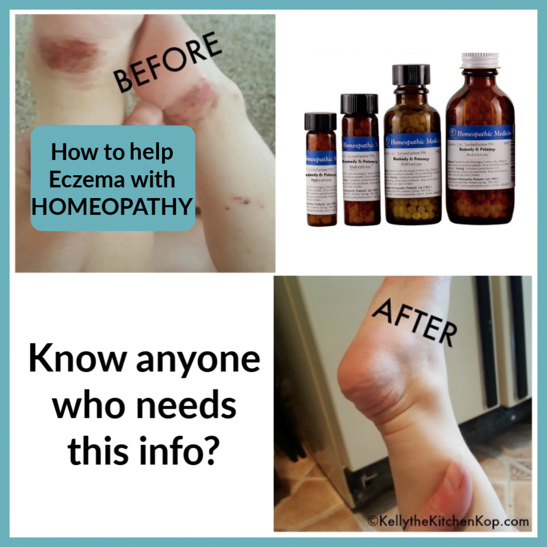 How to Help Eczema with Homeopathy (Another success story