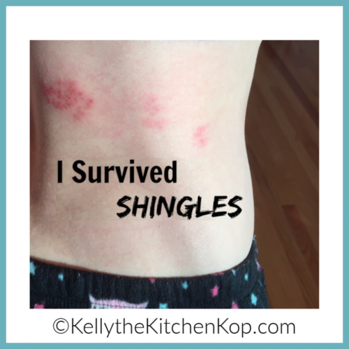 Best Natural Remedies for Shingles - (I Survived it Myself! And How ...