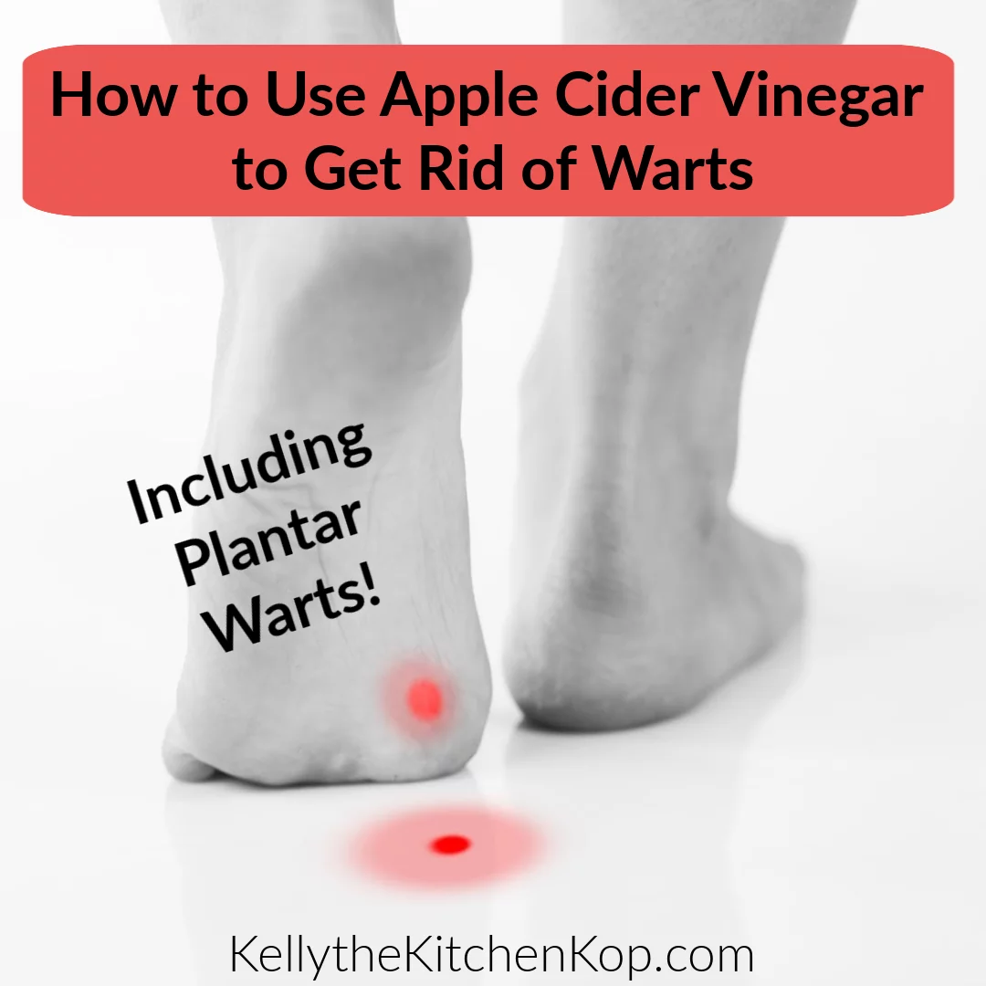 How to Use Apple Cider Vinegar to Remove Warts